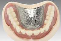 金属床義歯