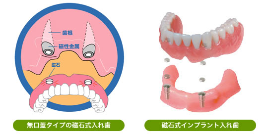 磁石式入れ歯とインプラント