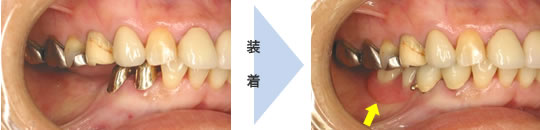 コーヌスクローネ