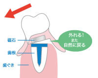 マグネットデンチャー