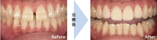 ラミネートベニアの症例