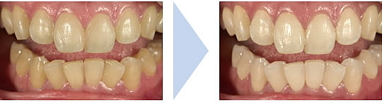 ホワイトニングの症例