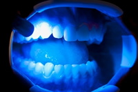 オフィスホワイトニング