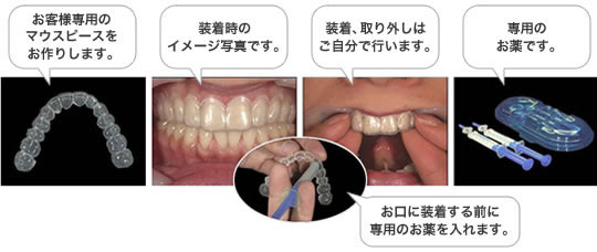 ホームホワイトニング